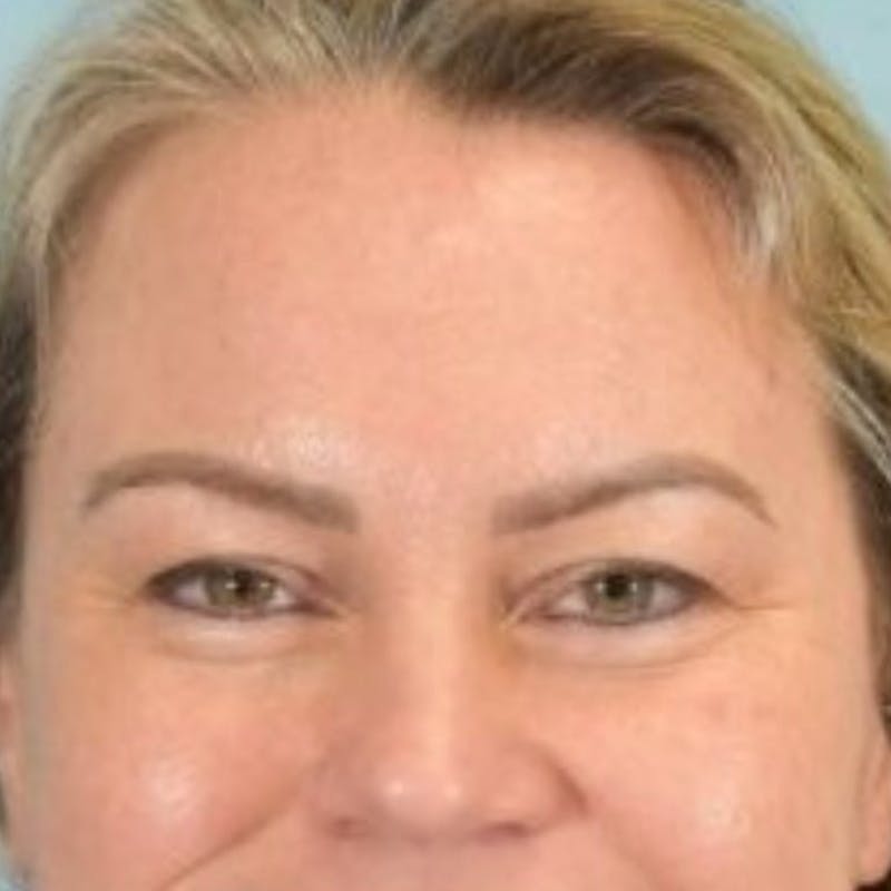 Blepharoplasty Before & After Gallery - Patient 242864 - Image 3