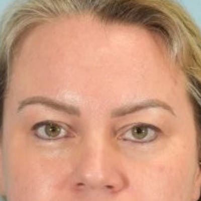 Blepharoplasty Before & After Gallery - Patient 242864 - Image 1