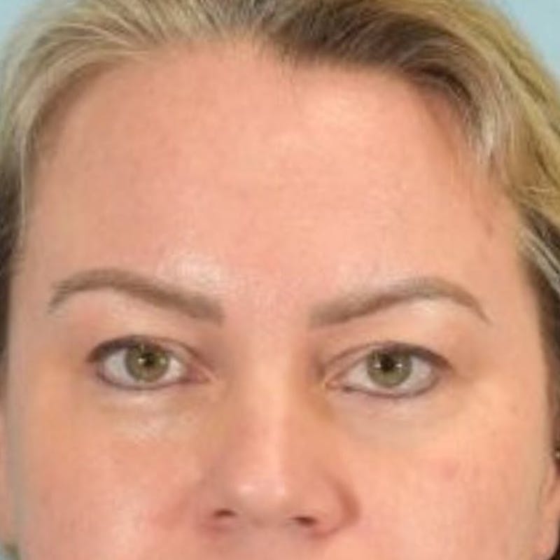 Blepharoplasty Before & After Gallery - Patient 242864 - Image 1