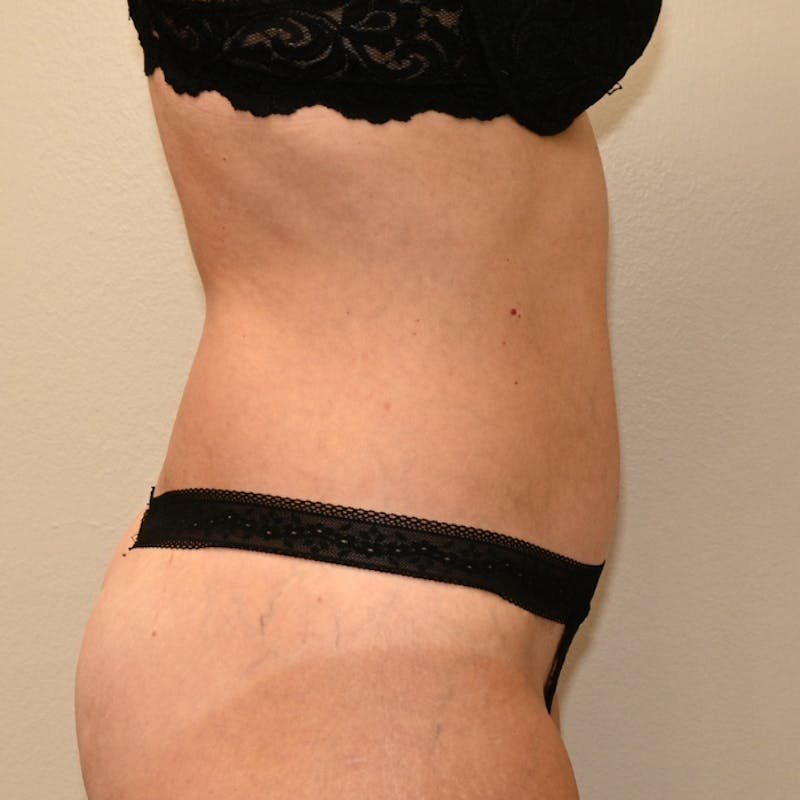 Body Lift Before & After Gallery - Patient 213180 - Image 4