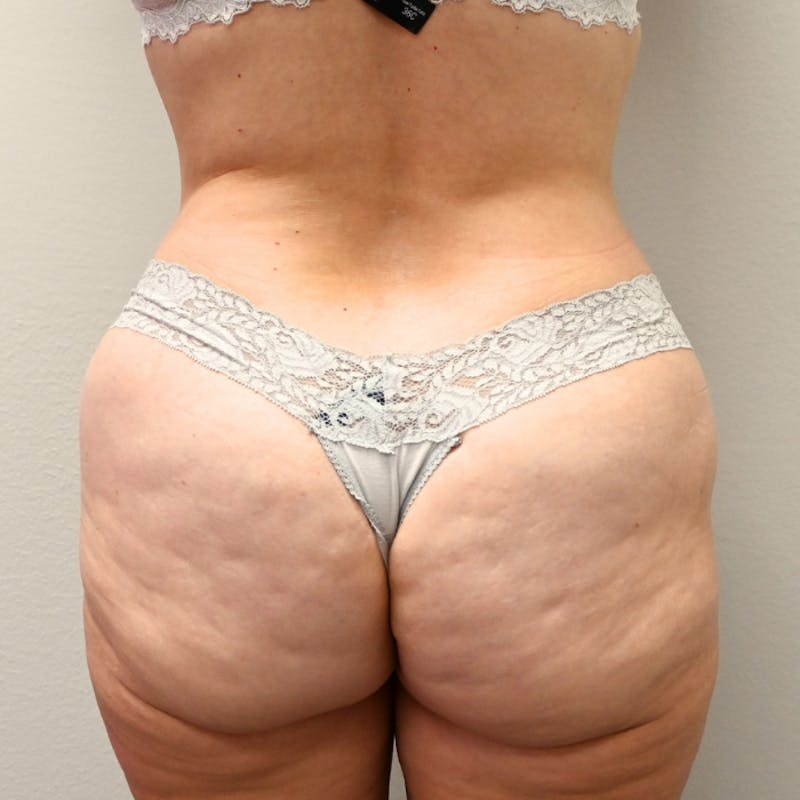 Body Lift Before & After Gallery - Patient 213180 - Image 7