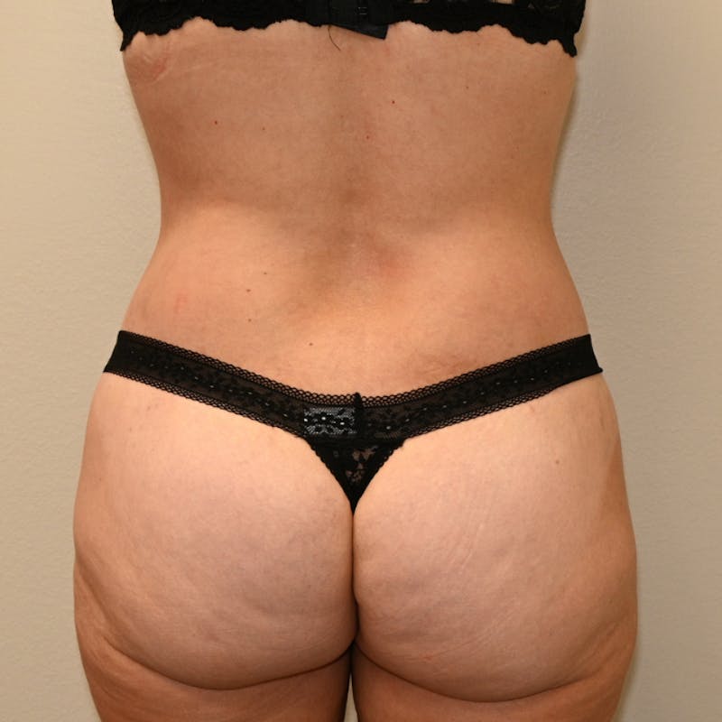 Body Lift Before & After Gallery - Patient 213180 - Image 8