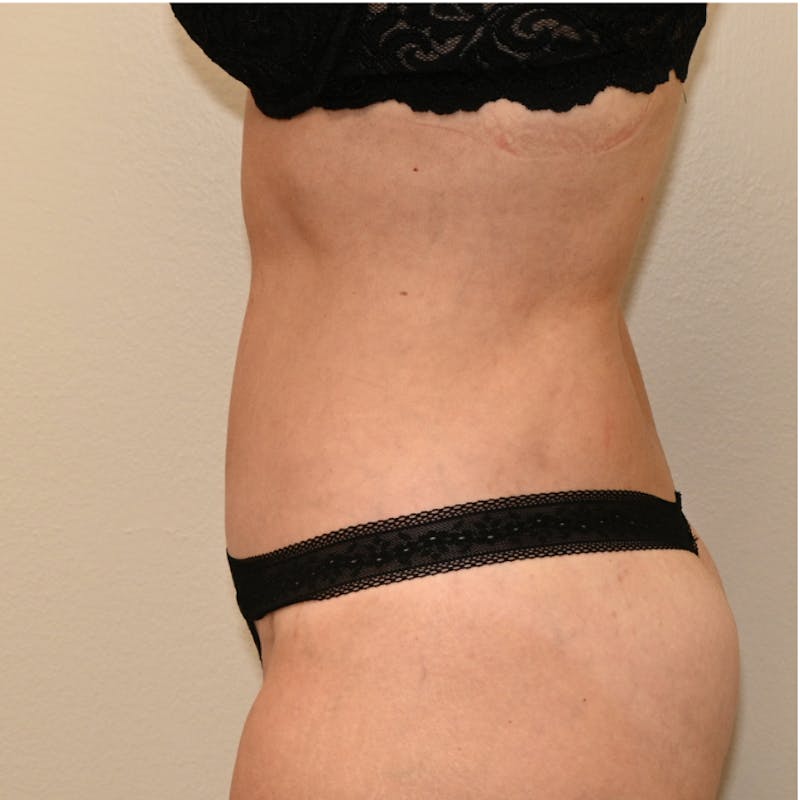 Body Lift Before & After Gallery - Patient 213180 - Image 6