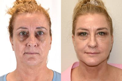 Facelift Before & After Gallery - Patient 164002 - Image 1