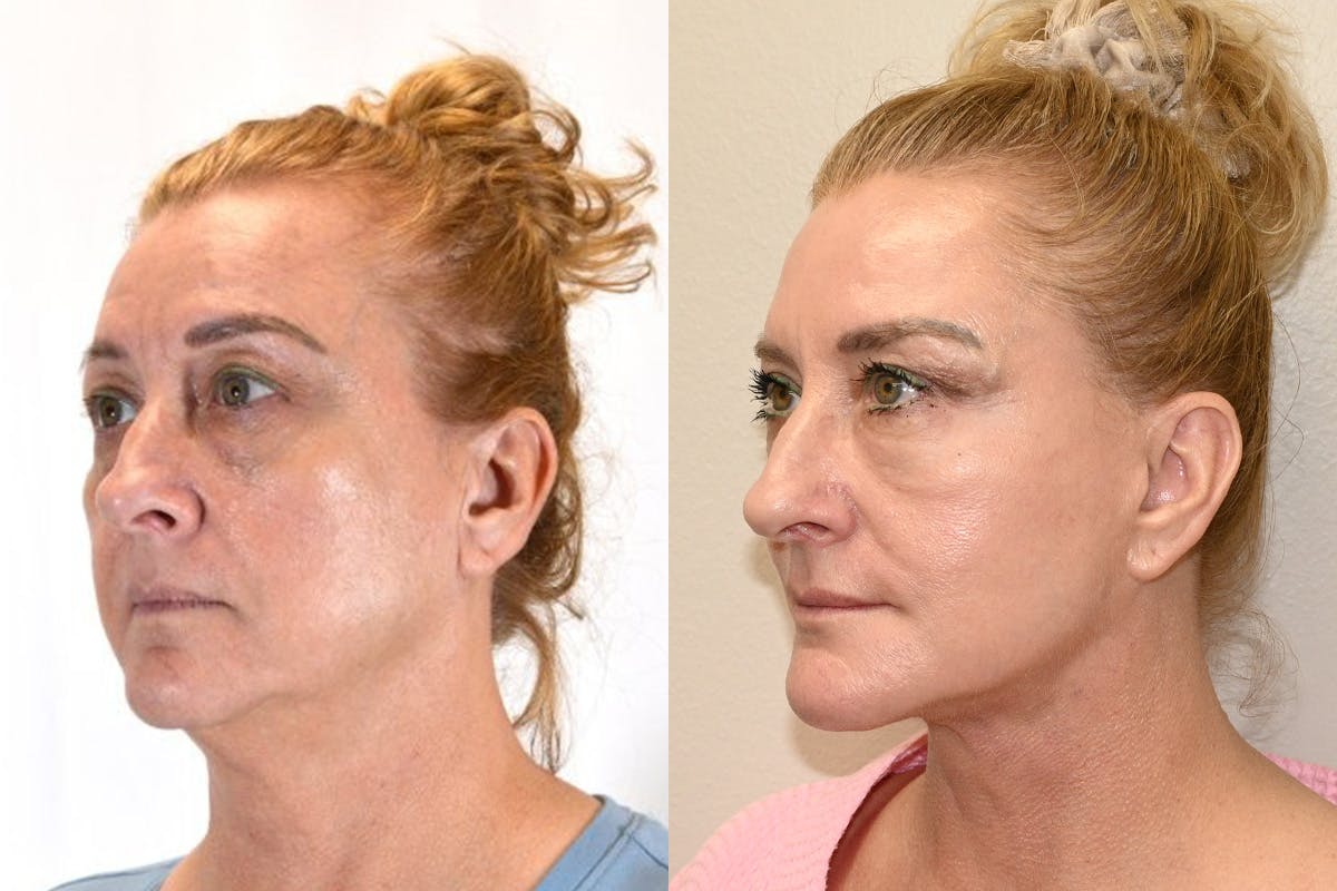 Facelift Before & After Gallery - Patient 164002 - Image 4