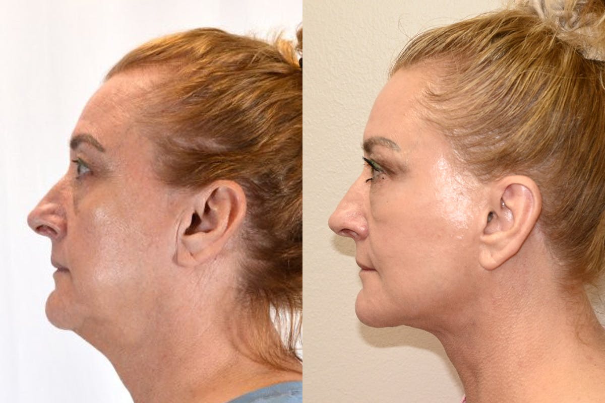 Facelift Before & After Gallery - Patient 164002 - Image 5