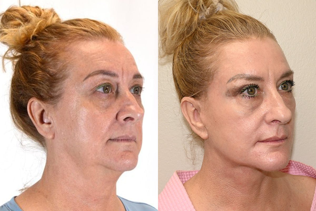 Facelift Before & After Gallery - Patient 164002 - Image 2