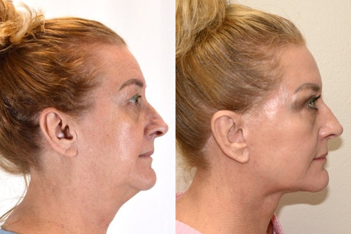 Facelift Before & After Gallery - Patient 164002 - Image 3