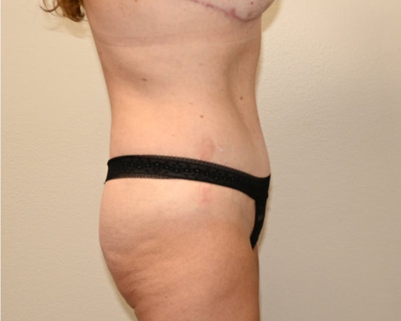 Tummy Tuck Before & After Gallery - Patient 364557 - Image 10