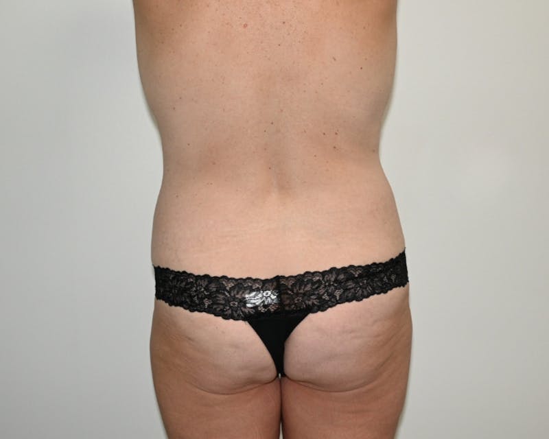 Tummy Tuck Before & After Gallery - Patient 364557 - Image 11