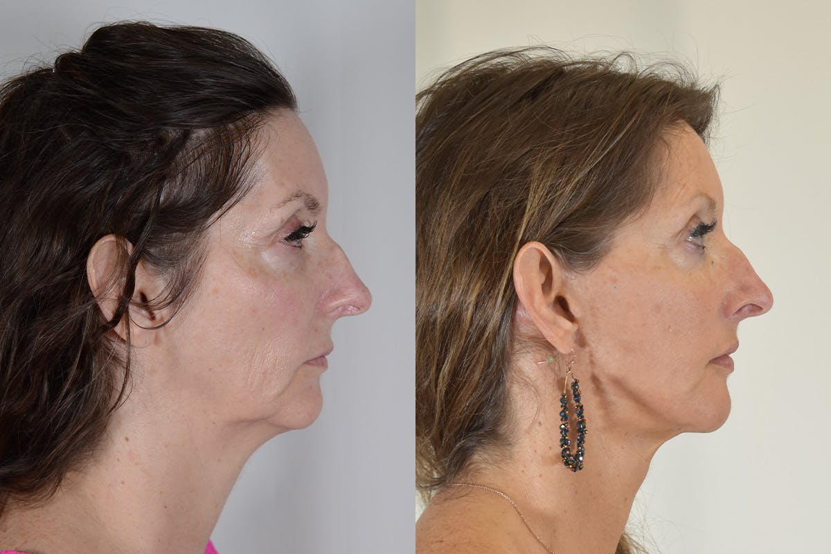 Facelift Before & After Gallery - Patient 854927 - Image 3