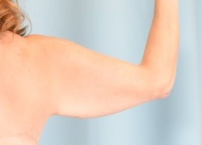 Arm Lift Before & After Gallery - Patient 318030 - Image 1