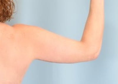 Arm Lift Before & After Gallery - Patient 318030 - Image 2