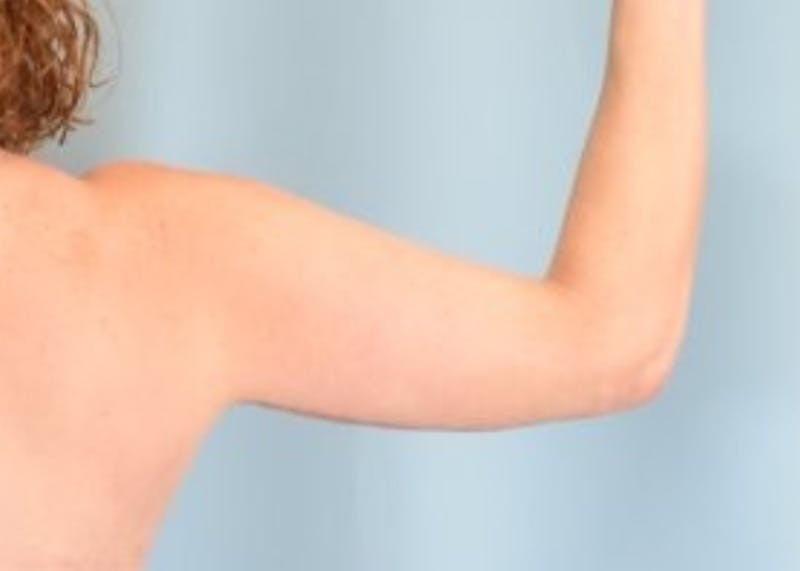 Arm Lift Before & After Gallery - Patient 318030 - Image 2