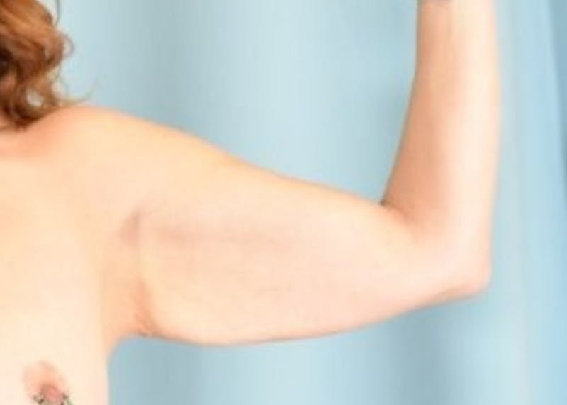 Arm Lift Before & After Gallery - Patient 318030 - Image 3
