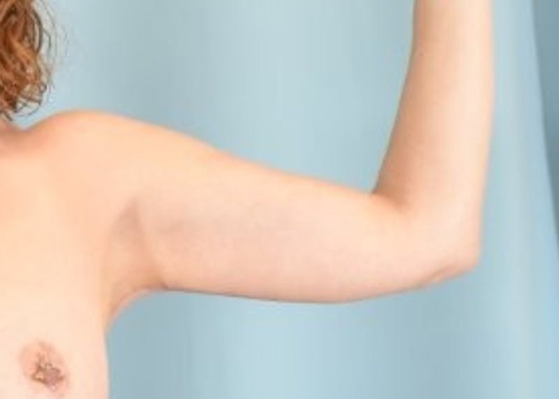 Arm Lift Before & After Gallery - Patient 318030 - Image 4