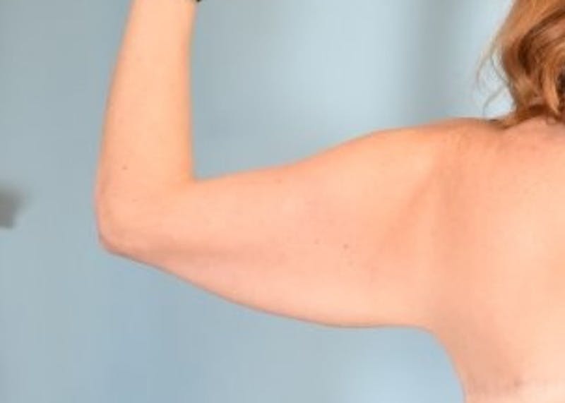 Arm Lift Before & After Gallery - Patient 318030 - Image 5