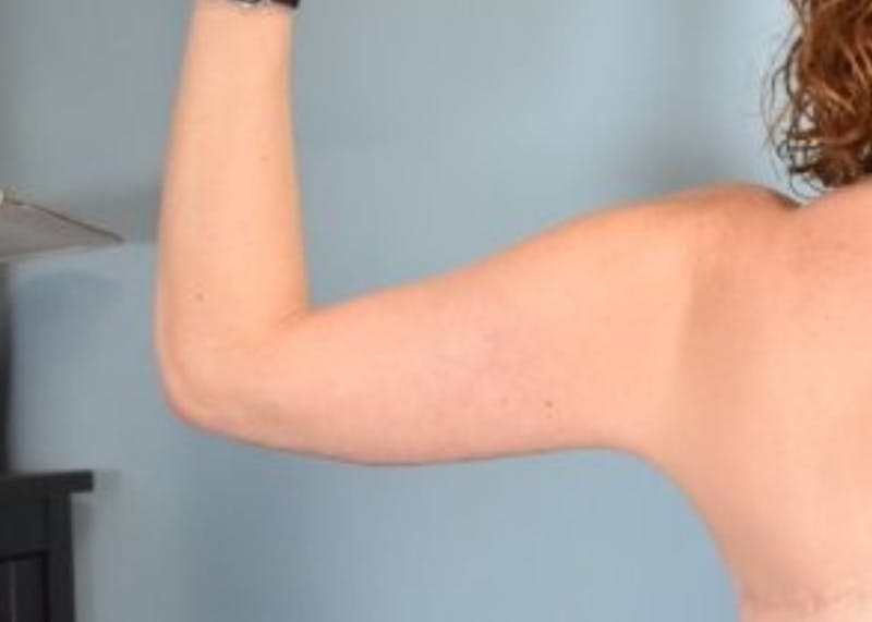 Arm Lift Before & After Gallery - Patient 318030 - Image 6