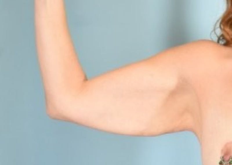 Arm Lift Before & After Gallery - Patient 318030 - Image 7
