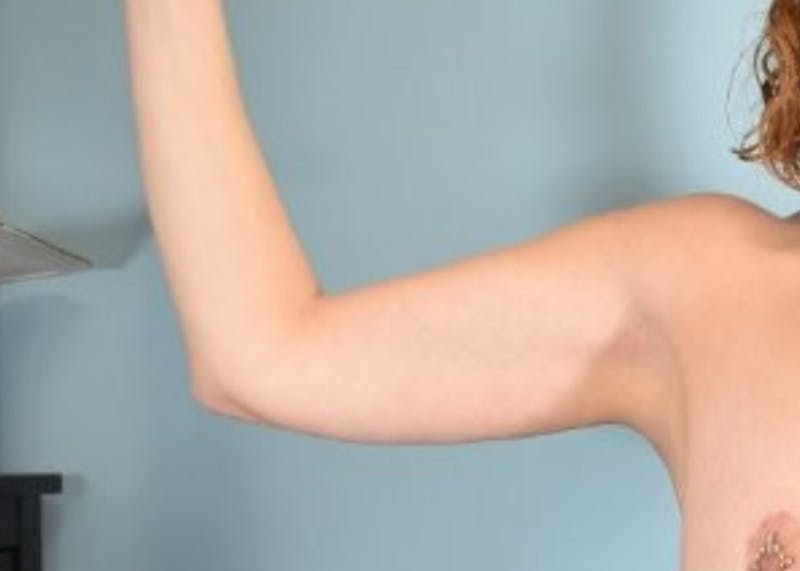 Arm Lift Before & After Gallery - Patient 318030 - Image 8