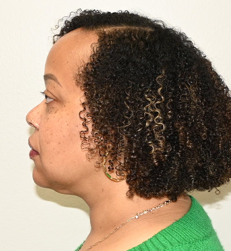 Liposuction Before & After Gallery - Patient 851166 - Image 10