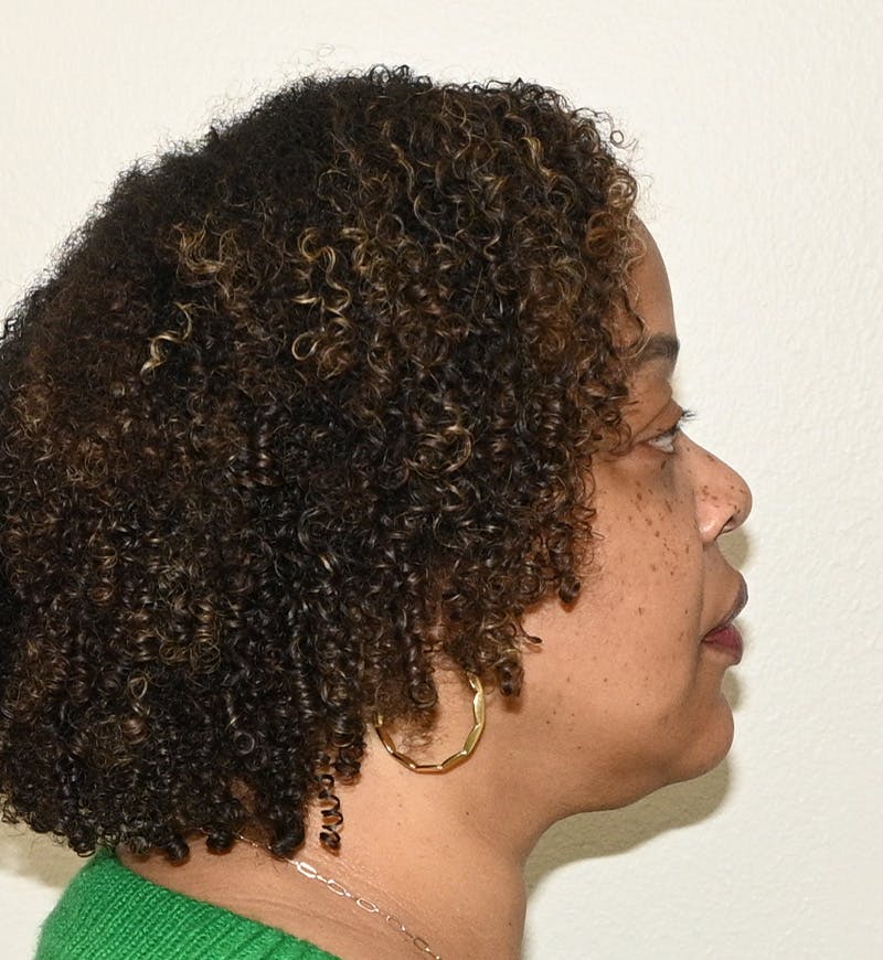 Liposuction Before & After Gallery - Patient 851166 - Image 6