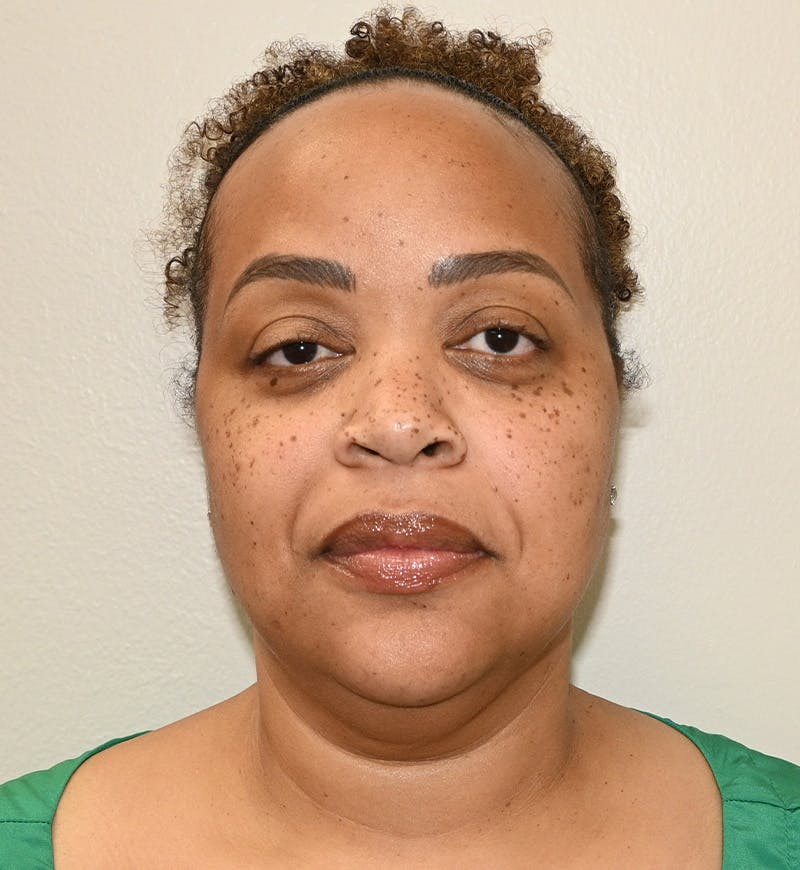 Liposuction Before & After Gallery - Patient 851166 - Image 1