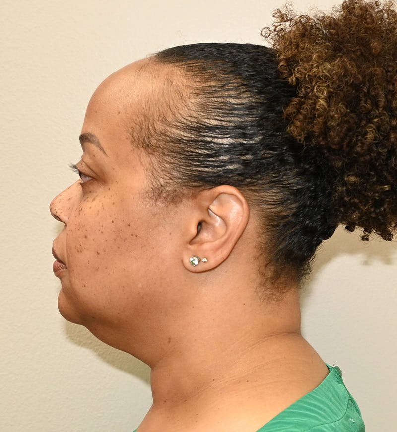 Liposuction Before & After Gallery - Patient 851166 - Image 9