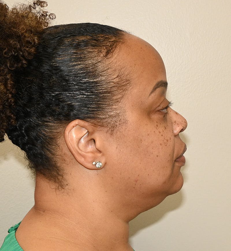 Liposuction Before & After Gallery - Patient 851166 - Image 5