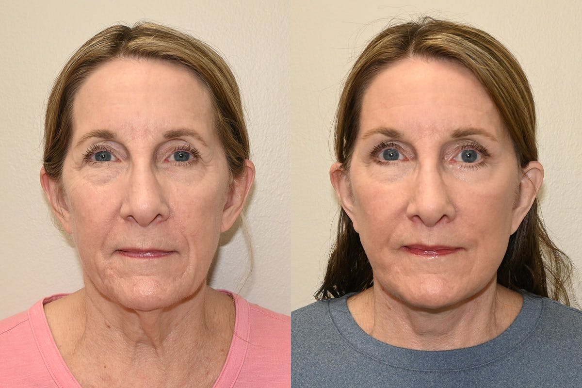 Facelift Before & After Gallery - Patient 207493 - Image 1