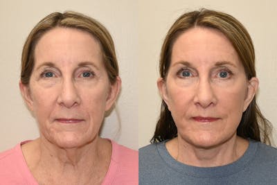Facelift Before & After Gallery - Patient 207493 - Image 1