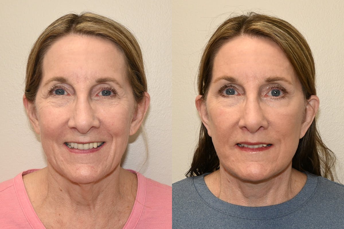 Facelift Before & After Gallery - Patient 207493 - Image 2