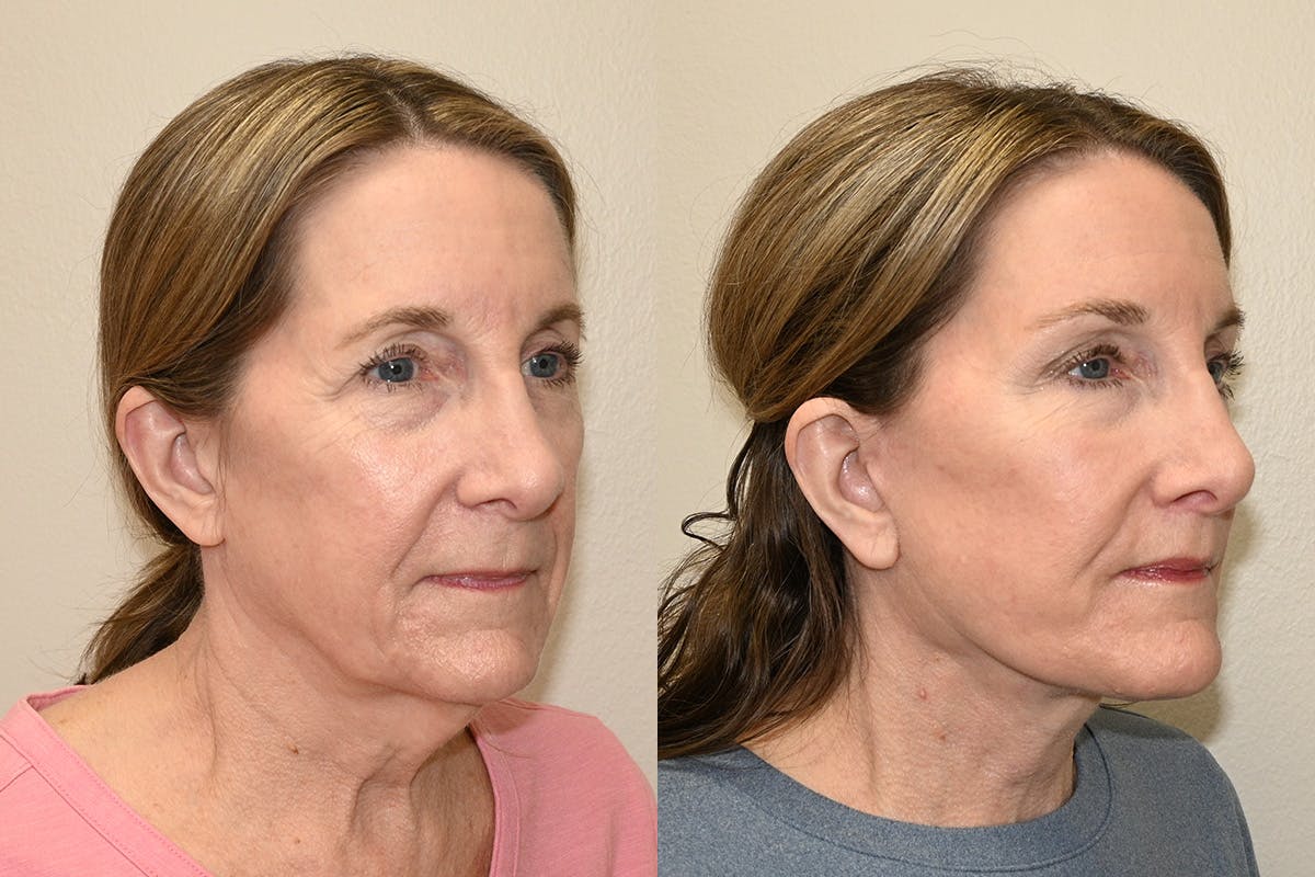 Facelift Before & After Gallery - Patient 207493 - Image 3