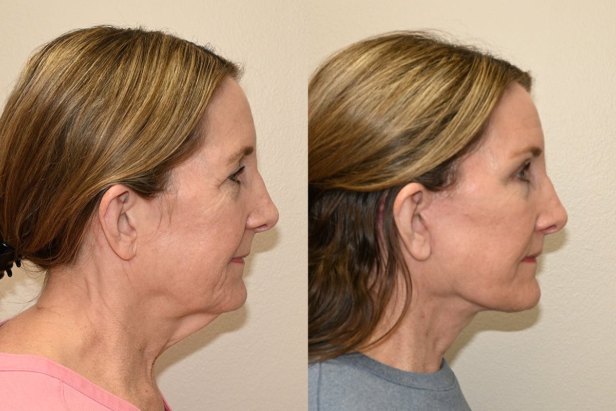 Facelift Before & After Gallery - Patient 207493 - Image 4