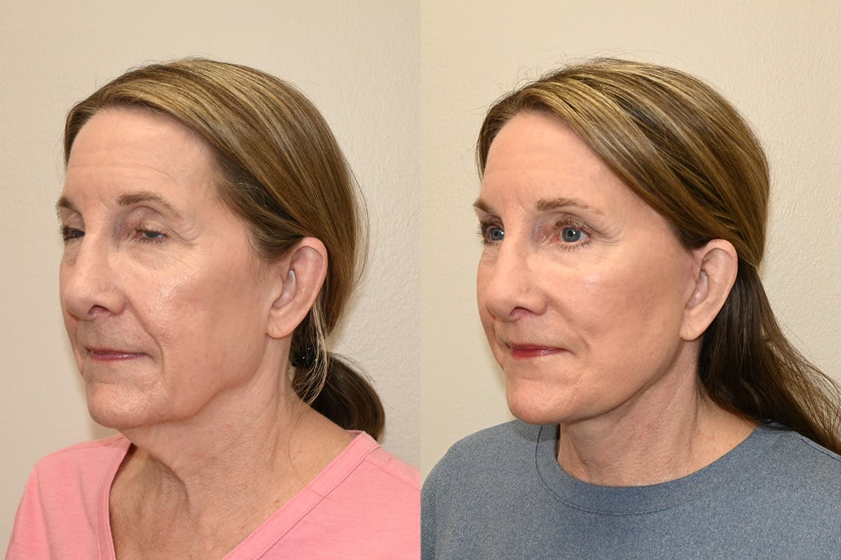Facelift Before & After Gallery - Patient 207493 - Image 5