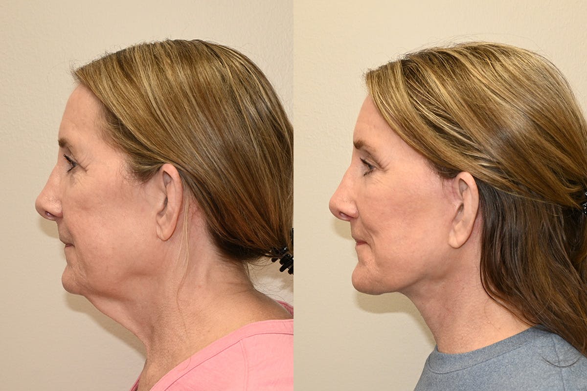 Facelift Before & After Gallery - Patient 207493 - Image 6