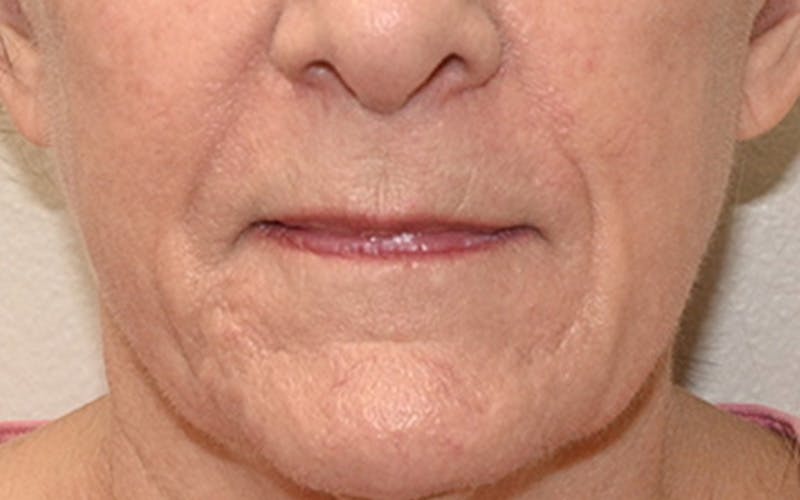 Lip Lift Before & After Gallery - Patient 323246 - Image 1
