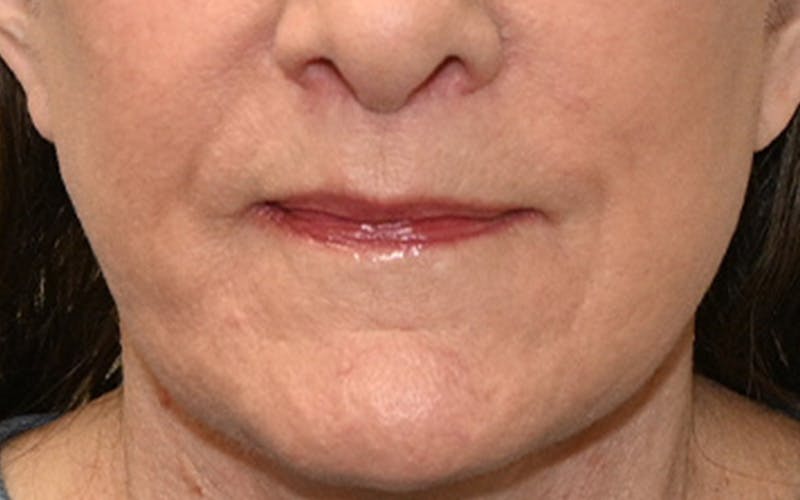 Lip Lift Before & After Gallery - Patient 323246 - Image 2