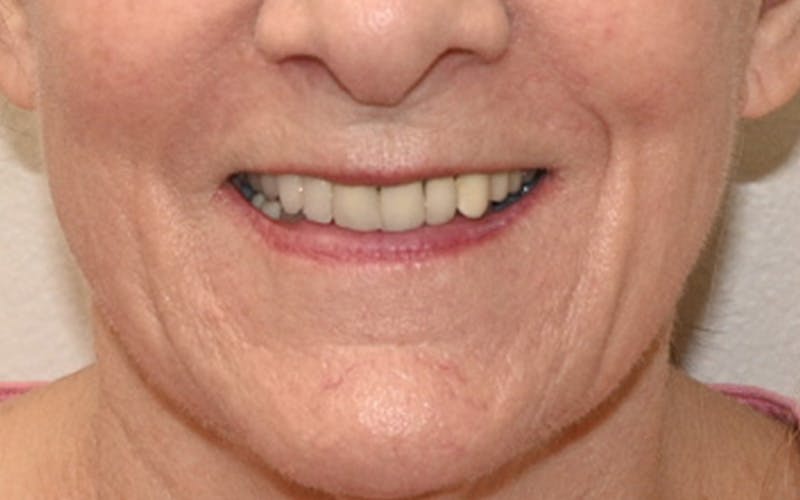 Lip Lift Before & After Gallery - Patient 323246 - Image 3
