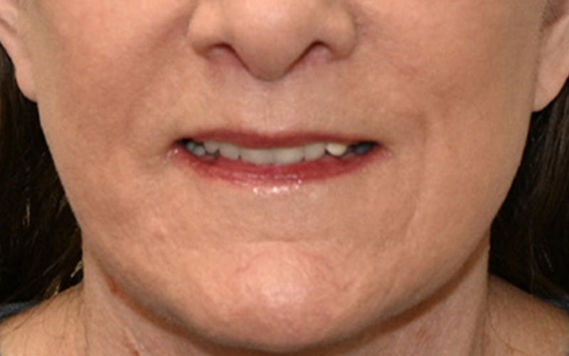 Lip Lift Before & After Gallery - Patient 323246 - Image 4