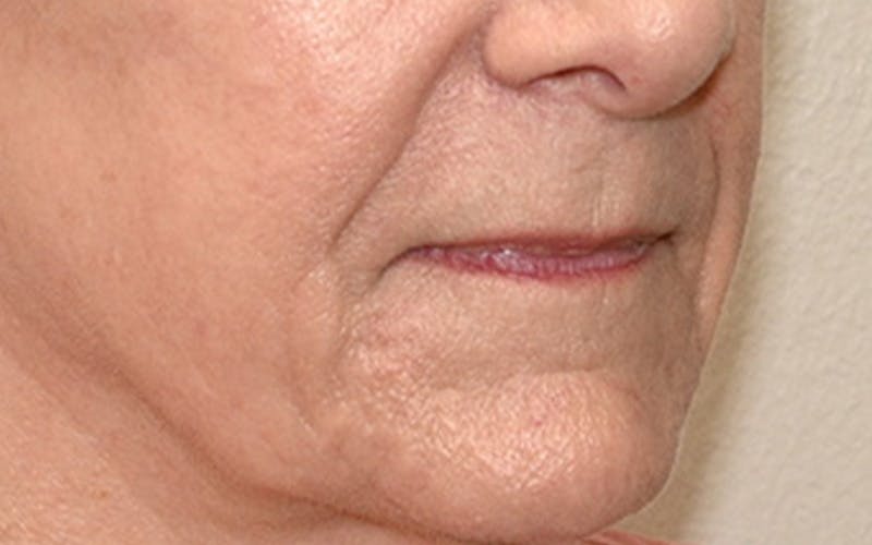 Lip Lift Before & After Gallery - Patient 323246 - Image 5