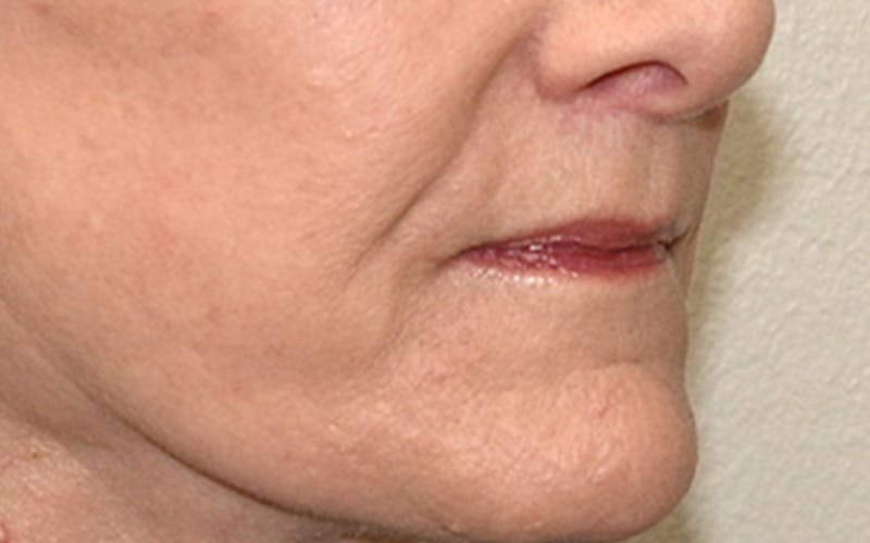 Lip Lift Before & After Gallery - Patient 323246 - Image 6