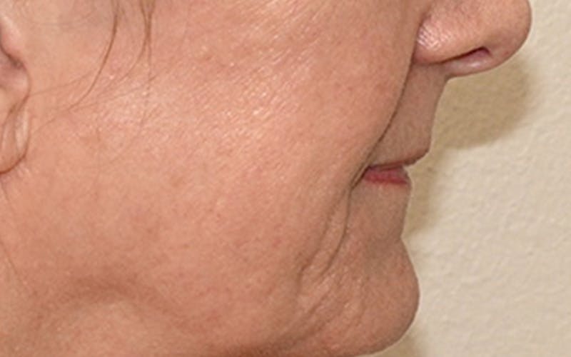 Lip Lift Before & After Gallery - Patient 323246 - Image 7