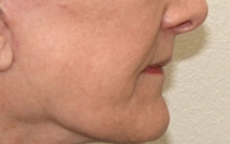 Lip Lift Before & After Gallery - Patient 323246 - Image 8
