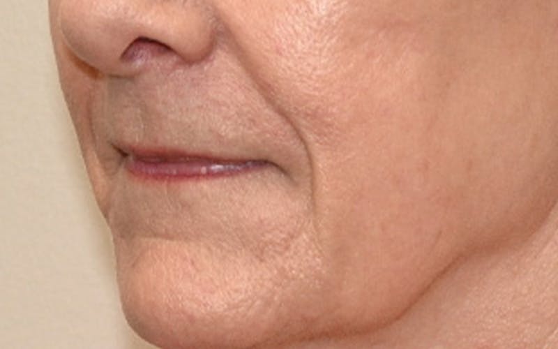 Lip Lift Before & After Gallery - Patient 323246 - Image 9