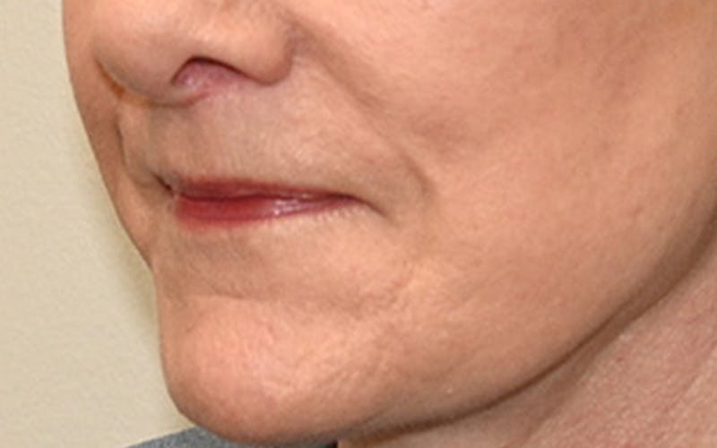 Lip Lift Before & After Gallery - Patient 323246 - Image 10