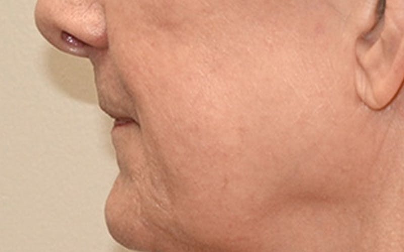 Lip Lift Before & After Gallery - Patient 323246 - Image 11