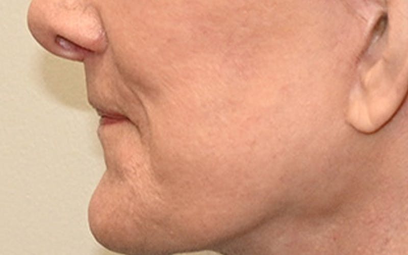 Lip Lift Before & After Gallery - Patient 323246 - Image 12