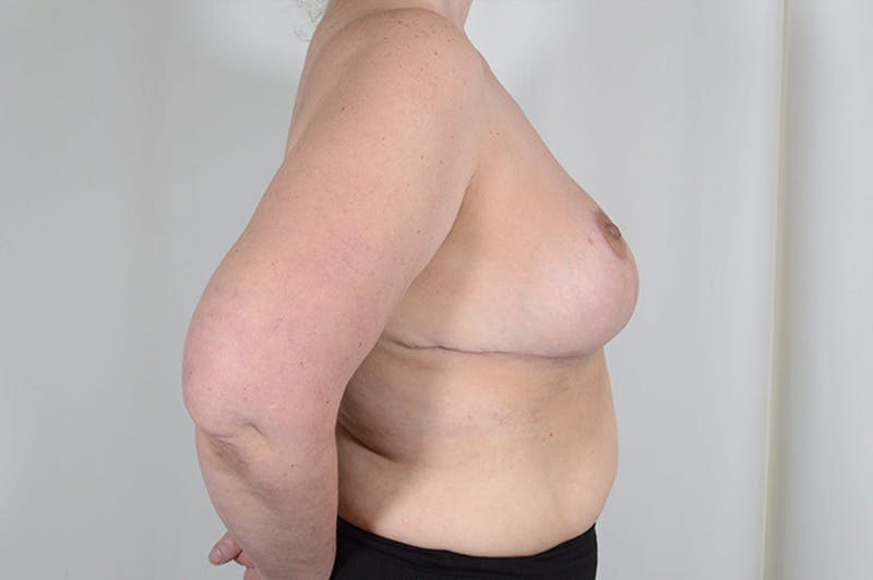 Breast Reduction Before & After Gallery - Patient 126050 - Image 6