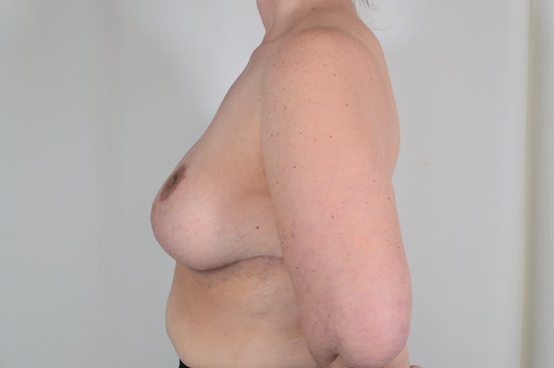 Breast Reduction Before & After Gallery - Patient 126050 - Image 10